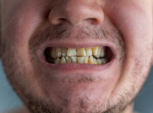 persona con denti sporchi