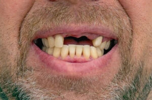 persona senza denti superiori